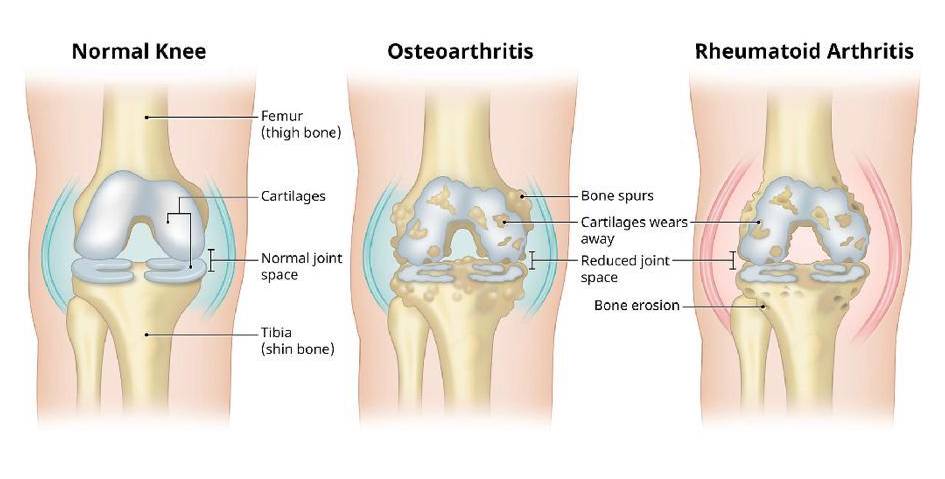 Image showing a normal knee, a knee with Osteoarthritis & progressive Rheumatoid Arthritis.
