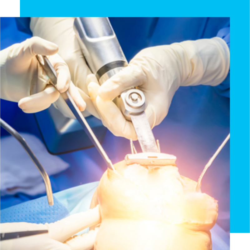 Medical experts performing a knee-replacement surgery.