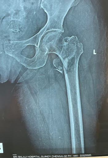 A pre-surgery x-ray of a shattered left hip (intertrochanteric fracture)