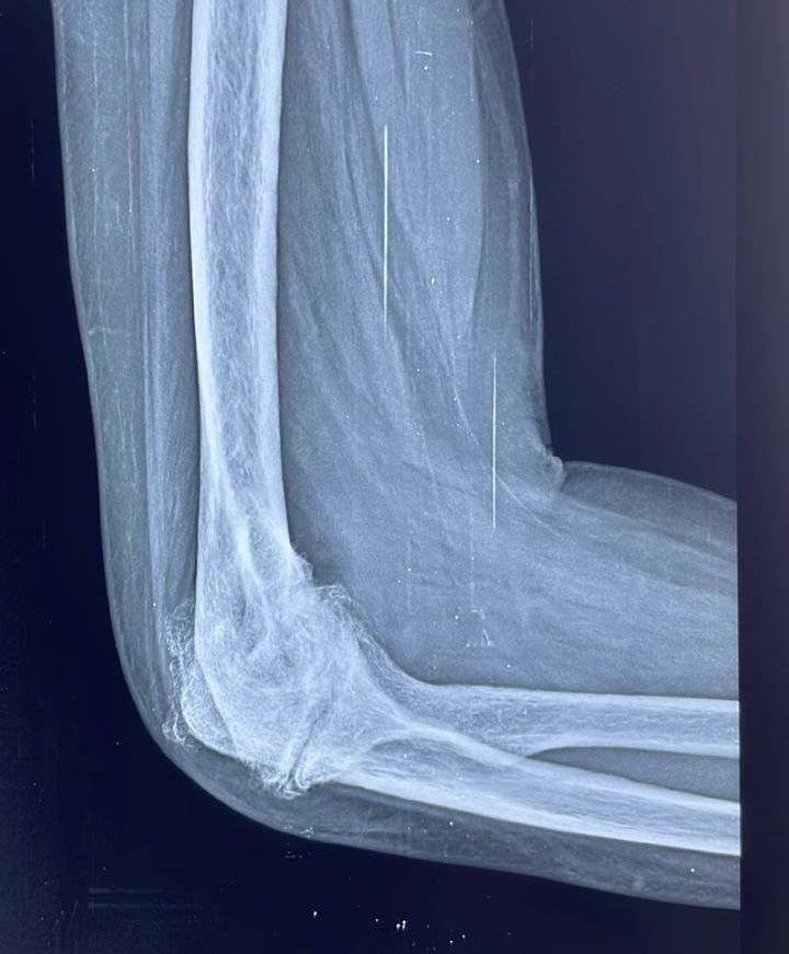 X-ray of an elbow showing severe destruction of the right elbow joint in a patient.