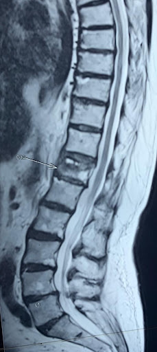 MRI image of a spine with a stable spine.