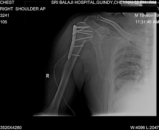Post-operative x-ray after surgical fixation of the fractured proximal Humerus shoulder.