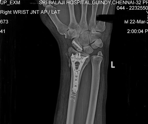 Post operative x-ray following reconstruction of the left wrist using plates and screws to stain perfect anatomical structure of the previously fractured joint.