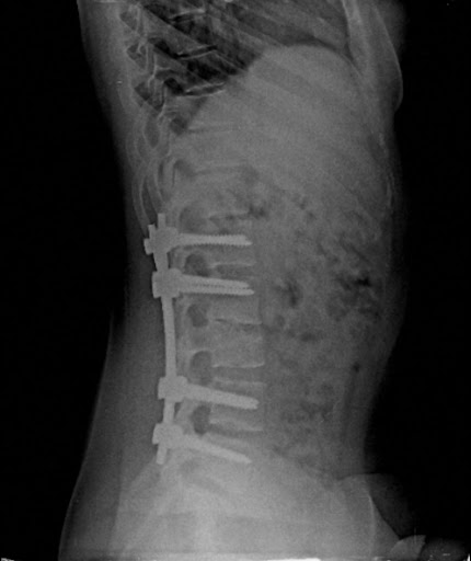 Post-operative x-ray following spinal fixation.