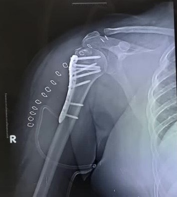 Post-operative x-ray for the same patient showcasing perfect anatomical alignment of the fractured proximal humerus shoulder.