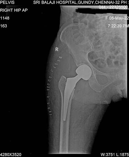 Post-operative x-ray of the patient after bipolar arthroplasty partial hip replacement.