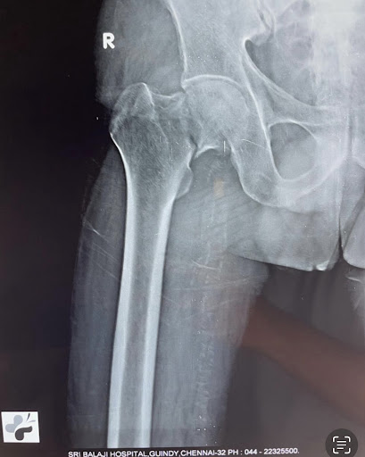 Pre-operative x-ray of a patient with neck of femur fracture of the right hip.