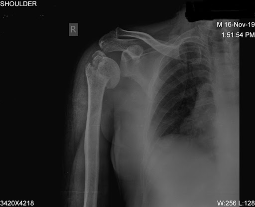 X-ray of severe fracture of the upper end of humerus bone proximal humerus of the shoulder before surgery.