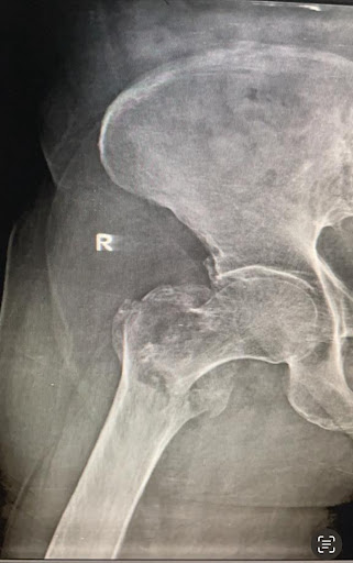 X- ray image showing a right hip unstable fracture before surgery.