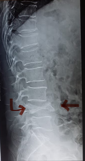 X-ray showing a high instance fracture of the spine.