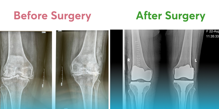 Pre and post-operative X-rays of damaged and repaired knees of a patient.