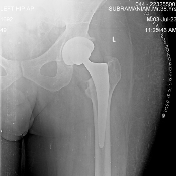 Hip Post-operative x-ray after left total hip replacement for the same patient