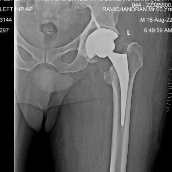 Hip Post-operative x-ray after total hip replacement of the left hip.