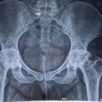 Hip X-ray of patient having severe arthritis of both hips due to rheumatoid arthritis.