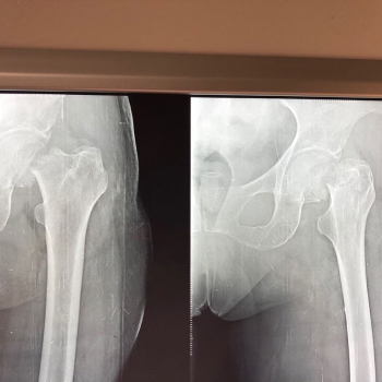Hip X-ray showing left hip fracture for a 71 year old.