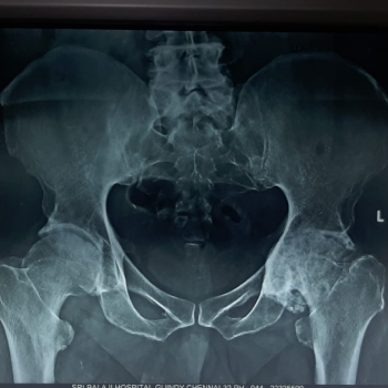 Hip X-ray showing severe arthritis and damage of left hip.