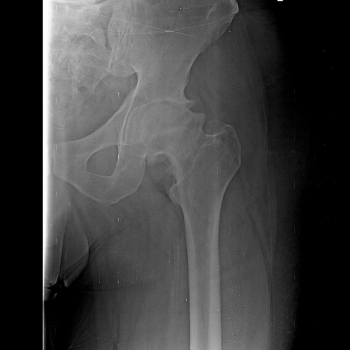 Hip X-ray showing severe damage of left hip joint due to vascular necrosis AVN of left hip.