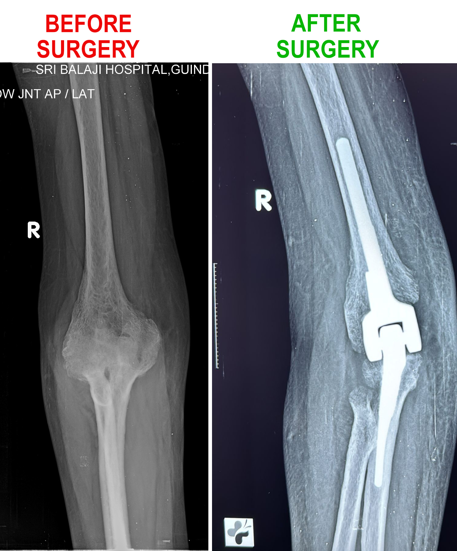 Pre and post-surgery X-rays of elbow replacement surgery in a patient at Sri Balaji hospital.