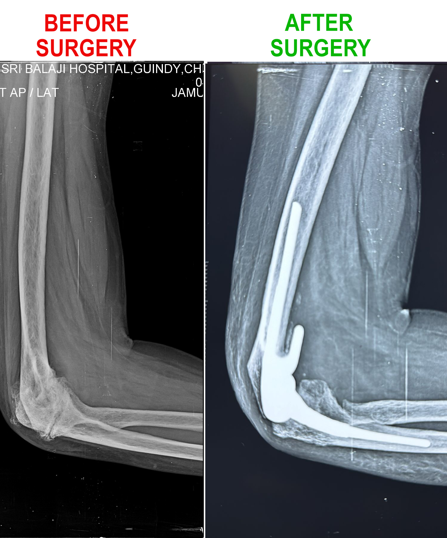 Pre and post-surgery X-rays of elbow replacement surgery in a patient.