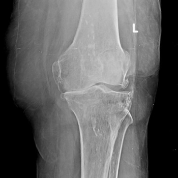 Knee-X-ray-of-a-severely-damaged-knee-of-an-81-year-old-lady.