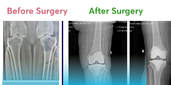 Pre and post-operative X-rays of damaged and repaired knees.