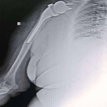 X-ray of Post-Operative  Shoulder Replacement.