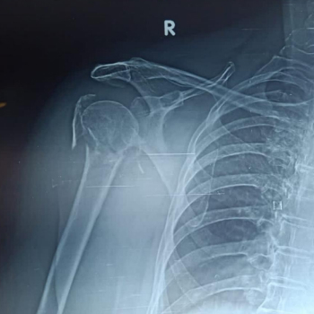 X-ray of a fractured right shoulder.