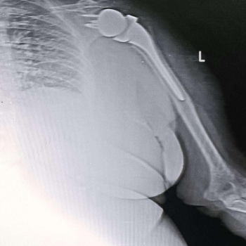 Post-operative X-ray of a fractured left shoulder.