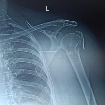 X-ray of a fractured left shoulder.