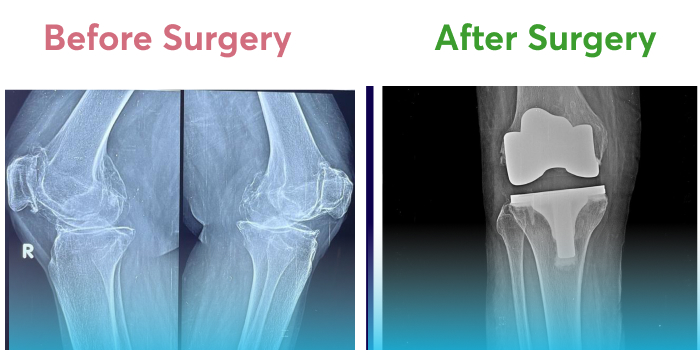 Pre and post-operative X-rays of damaged and repaired right knee.