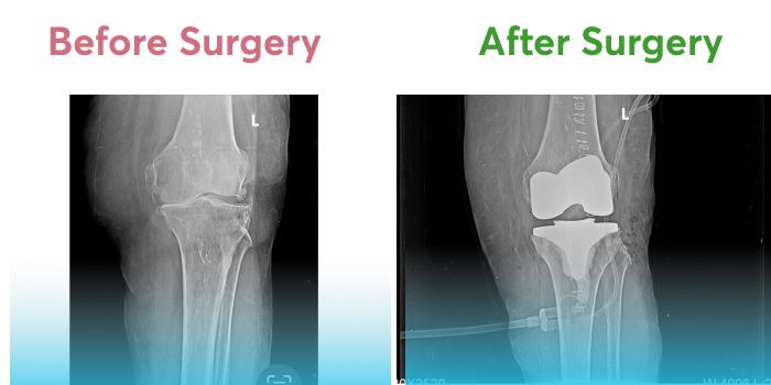 Pre and post-operative X-rays of damaged and repaired left knee.