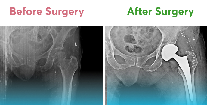 X-ray of a left hip fracture before and after partial hip replacement.