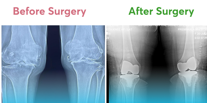 Pre and post-operative X-rays show the restoration of joint space.
