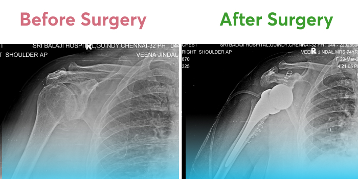 X-rays showing before and after the shoulder joint surgery.