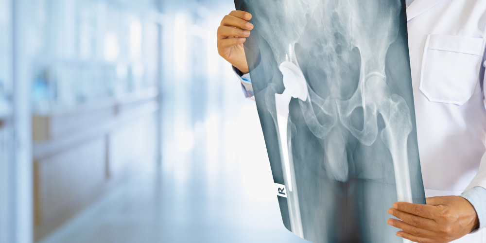 A doctor examines an X-ray of the hip prior to a total hip replacement procedure.